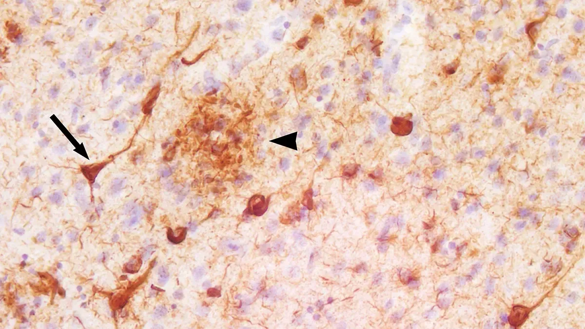 A micrograph showing abnormal tau protein in a section of the cerebral cortex from a person who had died with Alzheimer's disease.