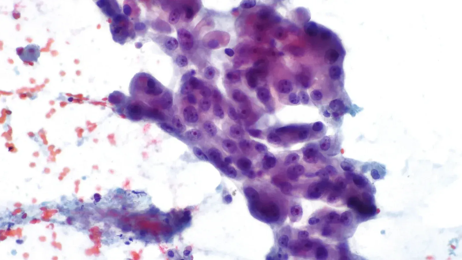Micrograph showing lung adenocarcinoma.
