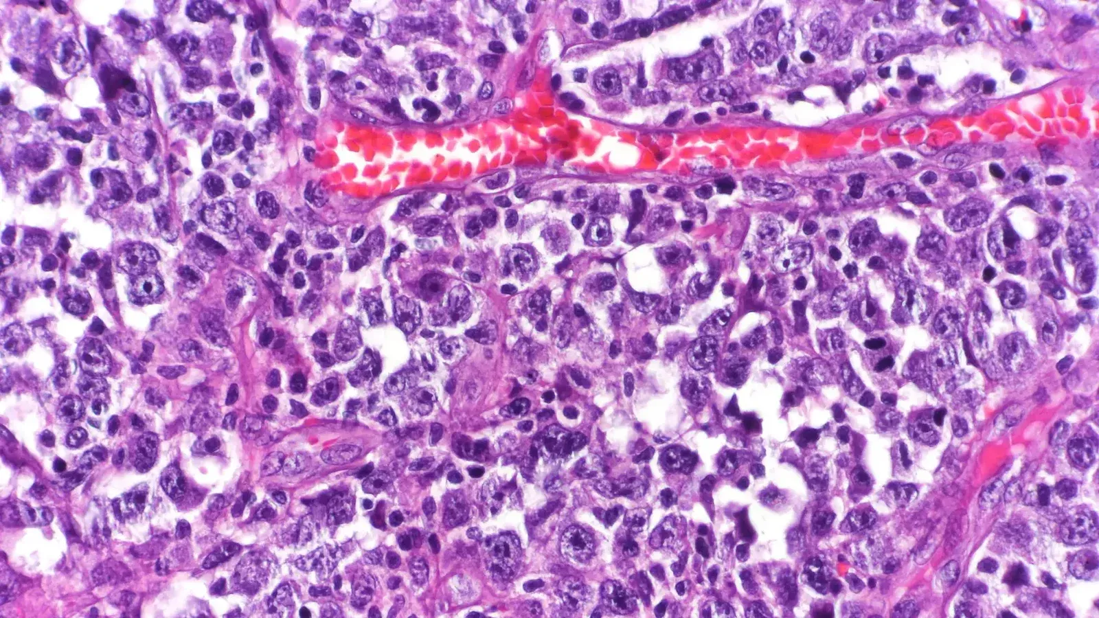 Diffuse large B-cell lymphoma (DLBCL) of the small intestine with mucosal ulceration and invasion of the mesenteric fat tissue.