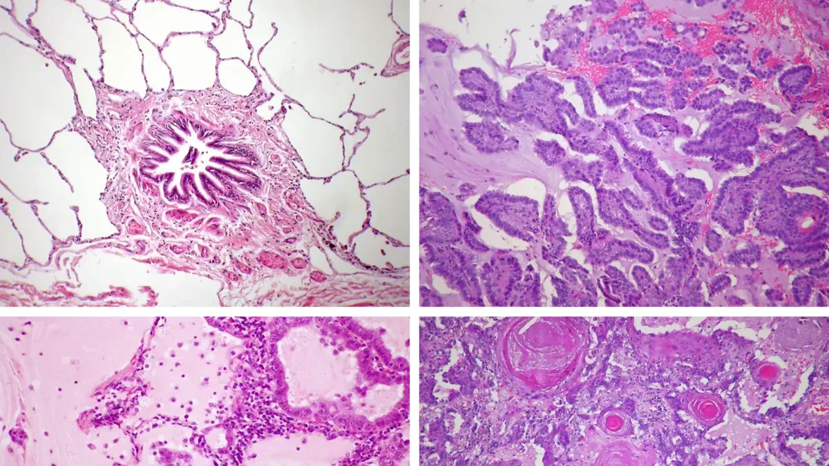 Four images of lung histology: (Top-left) Normal lung, bronchiole at center, with alveoli (mostly air) surrounding (Top-right) Lung adenocarcinoma showing papillary (finger-like) growth
