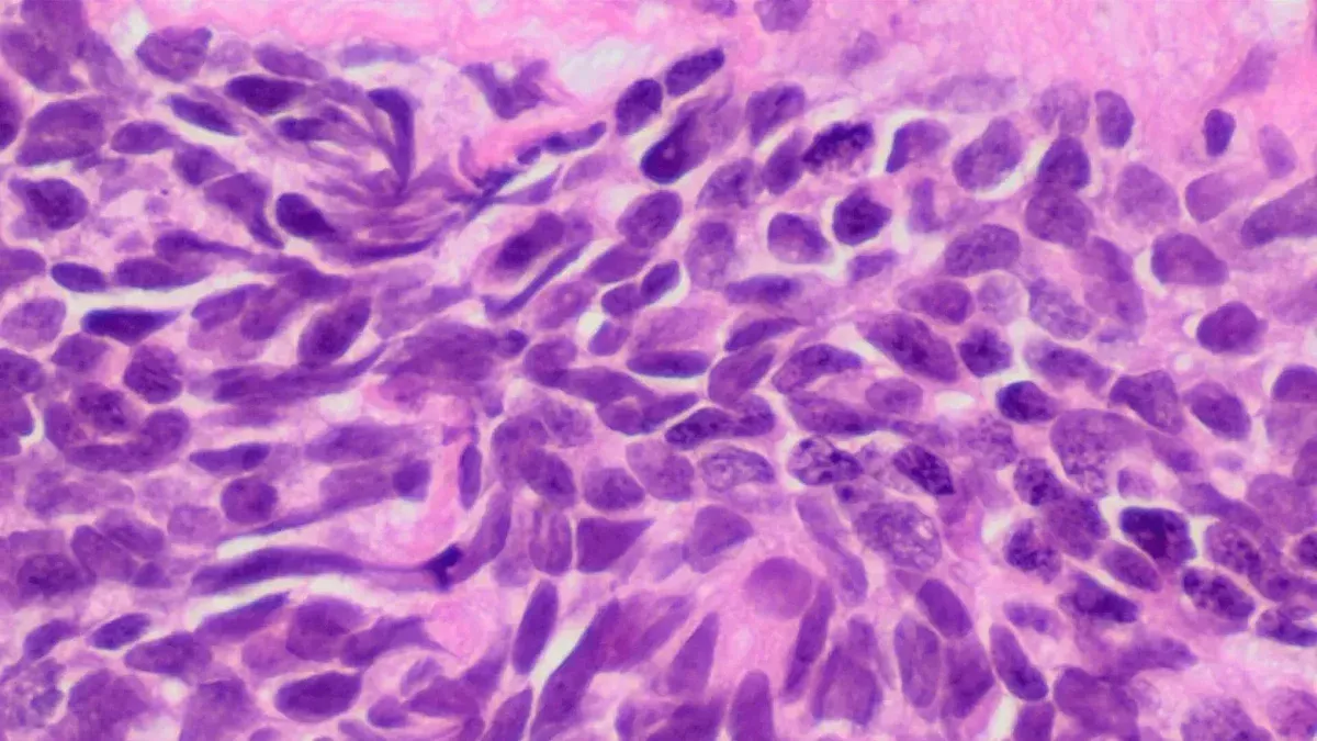 Histopathology of small cell carcinoma, H&E stain.