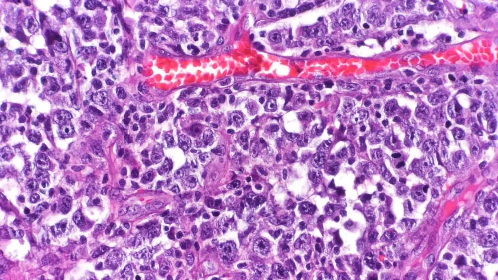 Epcoritamab con R-CHOP reduce 51% el riesgo de progresión o muerte en un ensayo de linfoma imagen del post