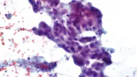 Micrograph showing lung adenocarcinoma.