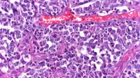 Diffuse large B-cell lymphoma (DLBCL) of the small intestine with mucosal ulceration and invasion of the mesenteric fat tissue.