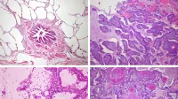 Four images of lung histology: (Top-left) Normal lung, bronchiole at center, with alveoli (mostly air) surrounding (Top-right) Lung adenocarcinoma showing papillary (finger-like) growth