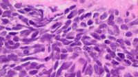 Histopathology of small cell carcinoma, H&E stain.