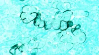 Título Cáncer de páncreas Descripción Células tumorales humanas del páncreas teñidas con una tinción inmunocitoquímica con verde metilo en el fondo y magnificadas hasta 400x.