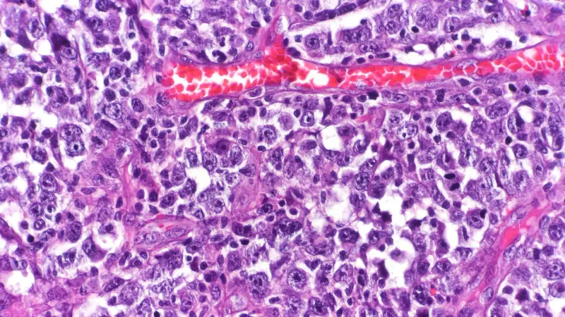 Diffuse large B-cell lymphoma (DLBCL) of the small intestine with mucosal ulceration and invasion of the mesenteric fat tissue.