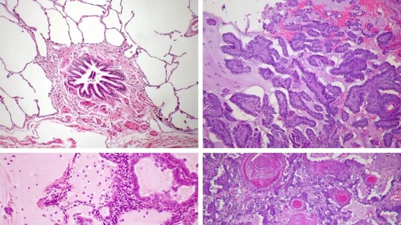 Four images of lung histology: (Top-left) Normal lung, bronchiole at center, with alveoli (mostly air) surrounding (Top-right) Lung adenocarcinoma showing papillary (finger-like) growth
