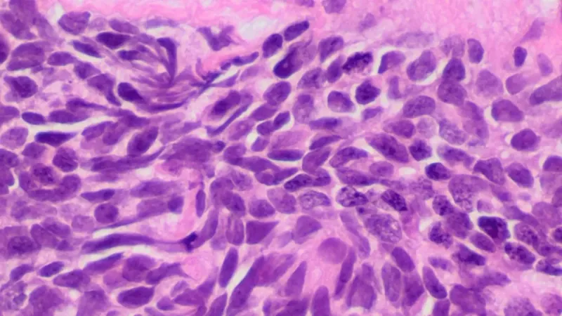 Histopathology of small cell carcinoma, H&E stain.
