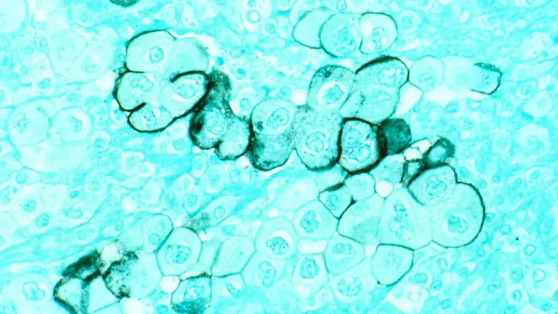 Título Cáncer de páncreas Descripción Células tumorales humanas del páncreas teñidas con una tinción inmunocitoquímica con verde metilo en el fondo y magnificadas hasta 400x.