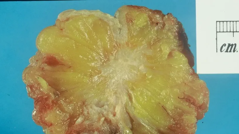 Excised human breast tissue, showing a stellate area of cancer 2cm in diameter.